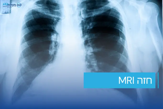 בדיקת MRI של חזה - תצלום רנטגן של החזה בזמן בדיקת MRI