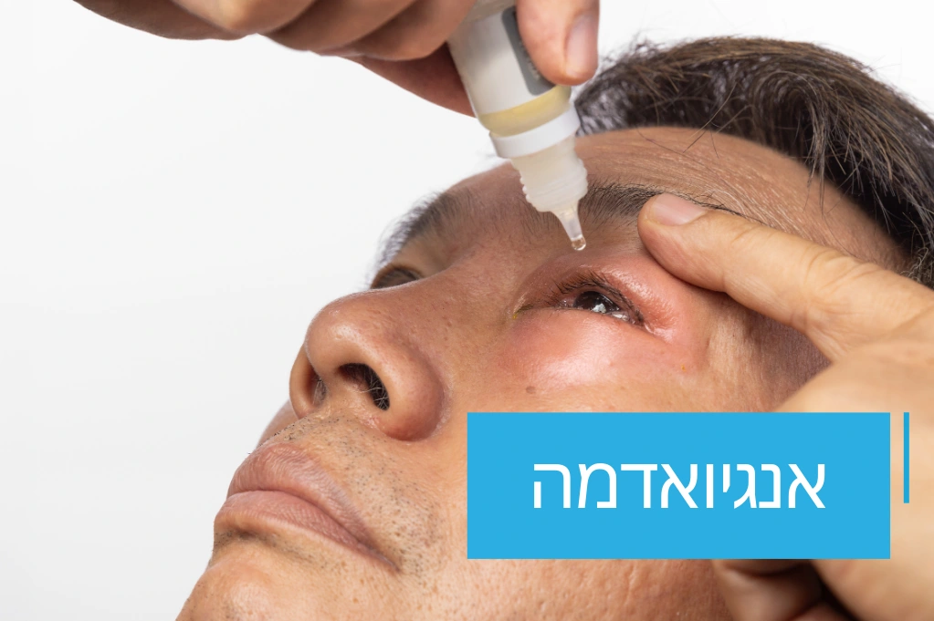 אנגיואדמה
