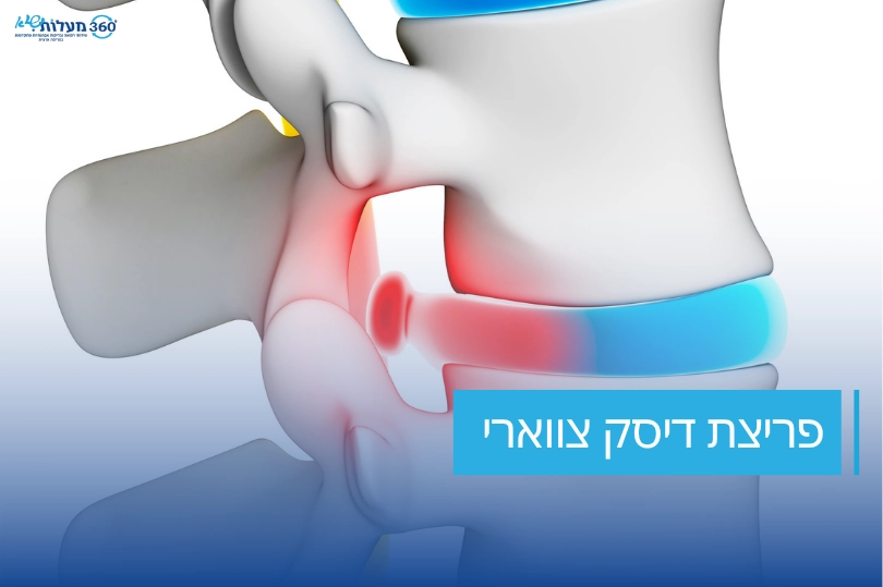 תמונה ראשית פריצת דיסק צווארי