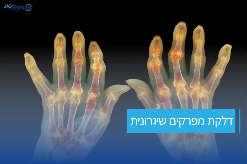 תמונה ראשית דלקת מפרקים שיגרונית