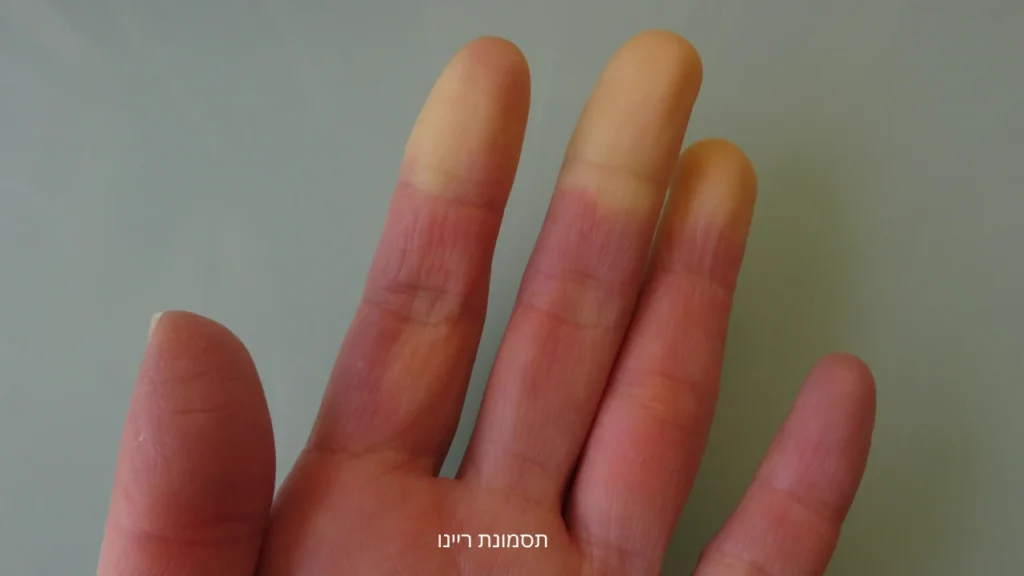 תסמונת ריינו - דוגמא
