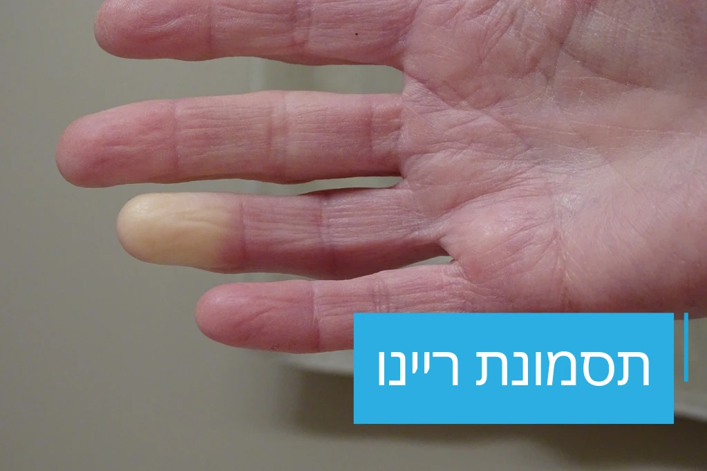 תסמונת ריינו - 360 מעלות שיא