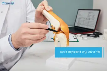 איך נראה קרע במיניסקוס ב mri - 360 מעלות שיא